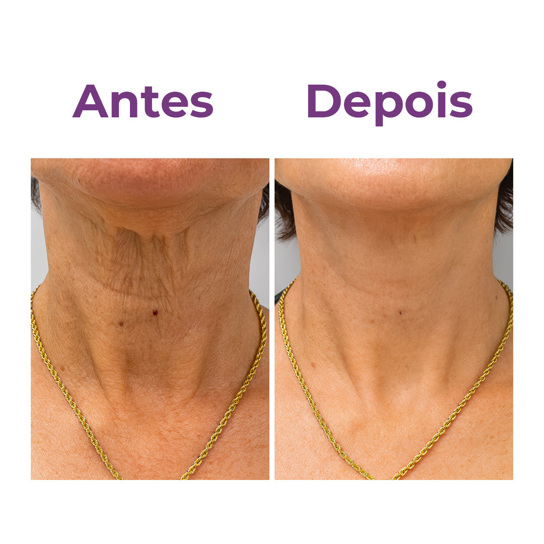 Neckfit - Adesivo para rugas e flacidez