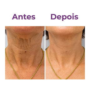 Neckfit - Adesivo para rugas e flacidez