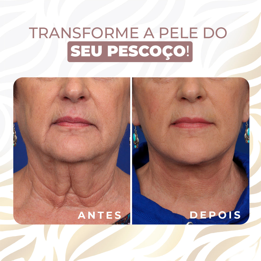 Neckfit - Adesivo para rugas